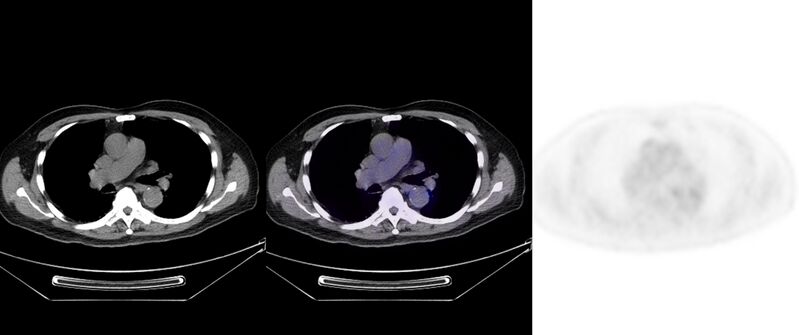 File:Non-Hodgkin lymphoma involving seminal vesicles with development of interstitial pneumonitis during Rituximab therapy (Radiopaedia 32703-33752 ax CT Fus PET 21).jpg