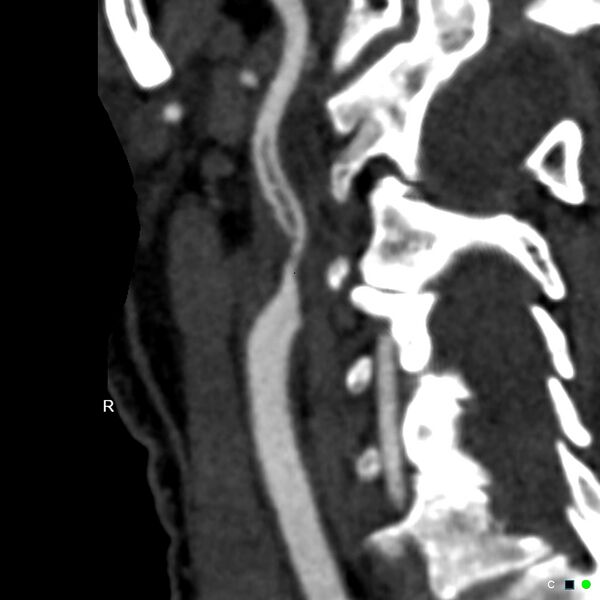 File:Non-occlusive intraluminal internal carotid artery thrombus (Radiopaedia 37751-39658 A 66).jpg