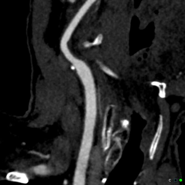 File:Non-occlusive intraluminal internal carotid artery thrombus (Radiopaedia 37751-39658 C 30).jpg