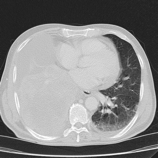 File:Non small-cell lung cancer (Radiopaedia 24467-24769 lung window 33).jpg