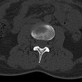 Normal CT lumbar spine (Radiopaedia 53981-60118 Axial bone window 38).jpg