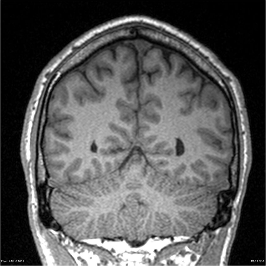Normal brain MRI (non-focal epilepsy protocol) (Radiopaedia 38571-40700 Coronal T1 31).jpg