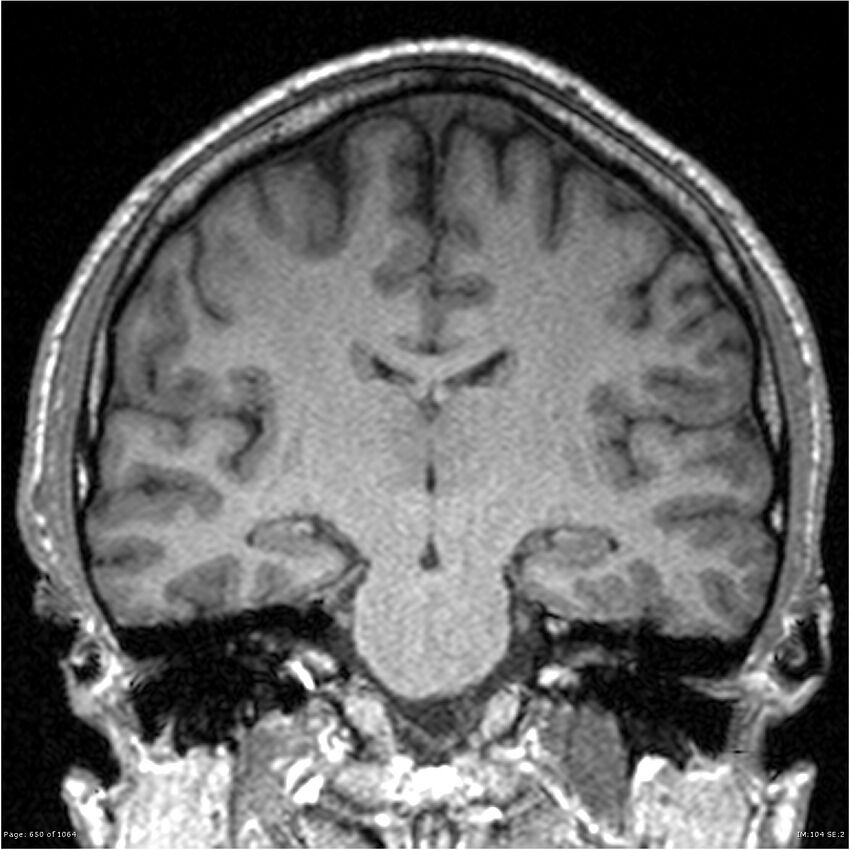 Normal brain MRI (non-focal epilepsy protocol) (Radiopaedia 38571-40700 Coronal T1 51).jpg