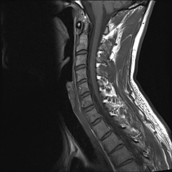 File:Normal cervical spine MRI (Radiopaedia 38418-40496 Sagittal T1 6).jpg