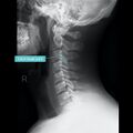 Normal cervical spine radiographs (Radiopaedia 32505-96697 A 9).jpeg