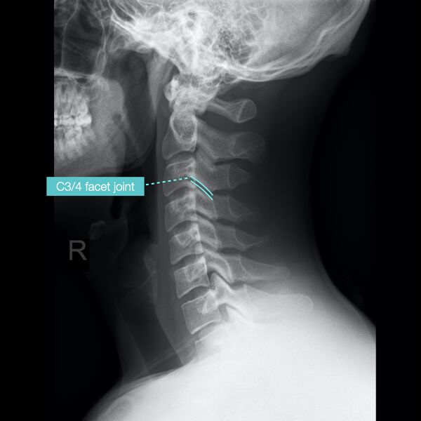File:Normal cervical spine radiographs (Radiopaedia 32505-96697 A 9).jpeg