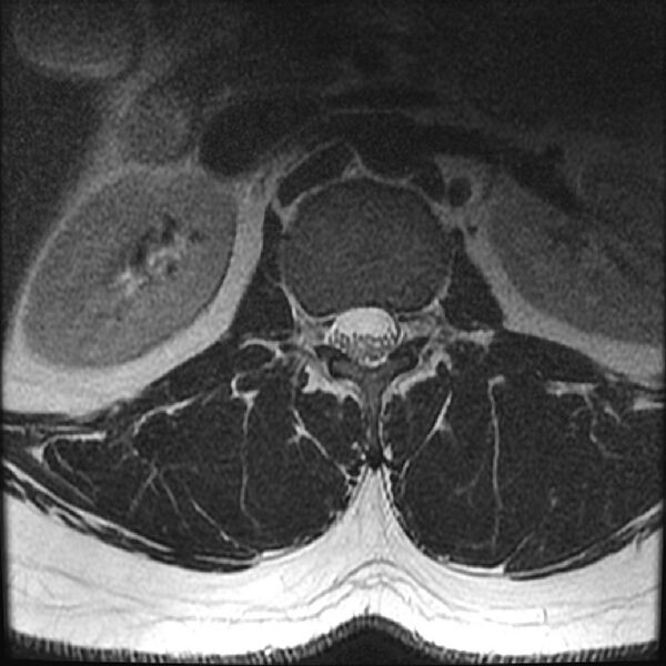 File:Normal lumbar spine MRI (Radiopaedia 43051-46311 Axial T2 1).jpg
