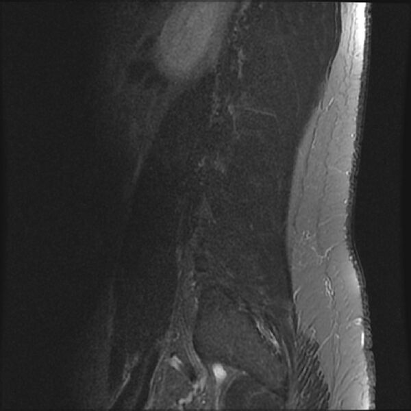 File:Normal lumbar spine MRI (Radiopaedia 43051-46311 Sagittal STIR 1).jpg