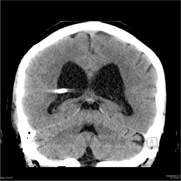 File:Normal pressure hydrocephalus (Radiopaedia 24415-24736 Coronal non-contrast 20).jpg