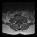 Normal spine MRI (Radiopaedia 77323-89408 Axial T1 8).jpg