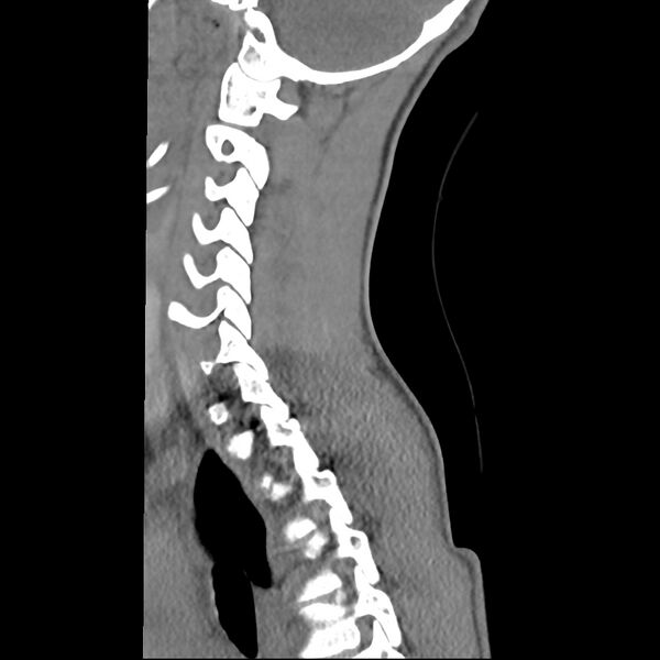 File:Normal trauma spine imaging (age 16) (Radiopaedia 45335-49358 C 10).jpg