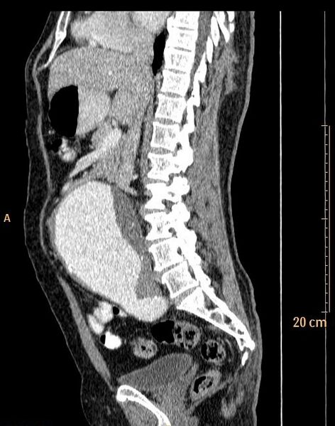 File:Abdominal aortic aneurysm (Radiopaedia 25985-26121 Sagittal C+ arterial phase 21).jpg