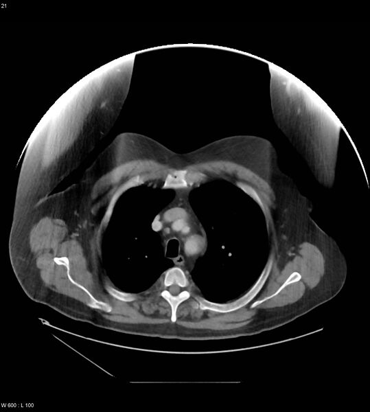 File:Abdominal aortic aneurysm with intramural hematoma then rupture (Radiopaedia 50278-55631 Axial C+ arterial phase 12).jpg