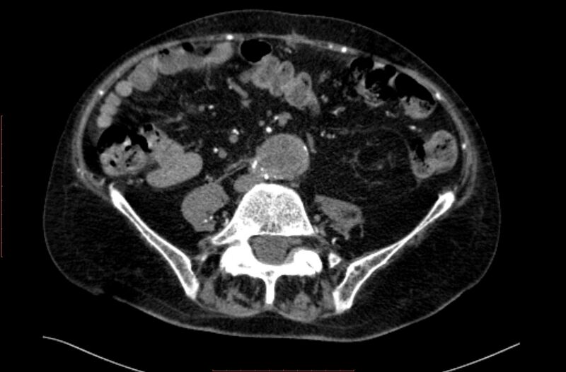 File:Abdominal aortic interposition tube graft and aneurysm thrombosis (Radiopaedia 71438-81857 Axial C+ arterial phase 125).jpg
