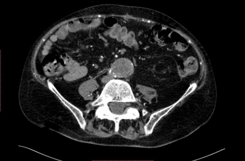 Abdominal aortic interposition tube graft and aneurysm thrombosis (Radiopaedia 71438-81857 Axial C+ arterial phase 125).jpg