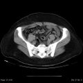 Abdominal wall endometriosis (Radiopaedia 25723-25885 Axial C+ portal venous phase 27).jpg