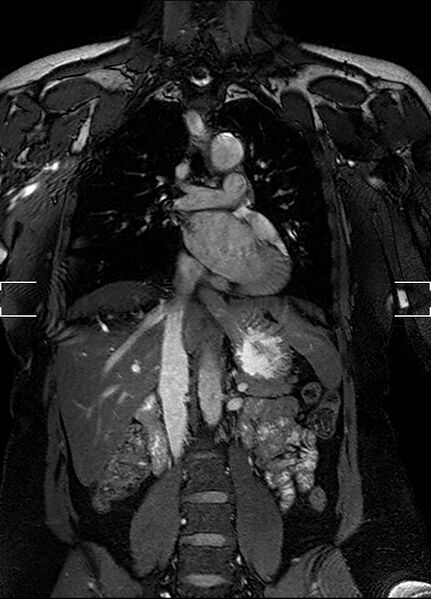 File:Aberrant right subclavian artery with background Takayasu arteritis (Radiopaedia 21423-21363 Coronal MRA 14).jpg