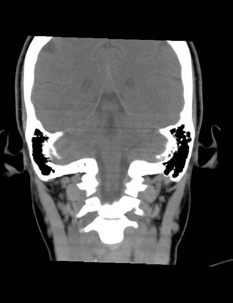 File:Accessory parotid glands (Radiopaedia 27289-27472 Coronal non-contrast 1).jpg