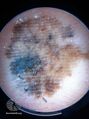 Acral lentiginous melanoma dermoscopy (DermNet NZ alm-dermoscopy-7).jpg