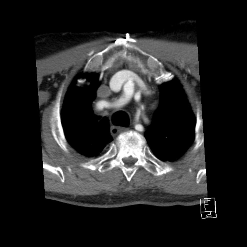 Acute ICA ischemic penumbra due to high-grade CCA stenosis (CT perfusion) (Radiopaedia 72038-82530 Axial C+ arterial phase 76).jpg
