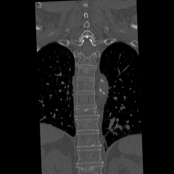 File:Acute and chronic vertebral compression fractures (Radiopaedia 31608-32494 Coronal bone window 26).jpg