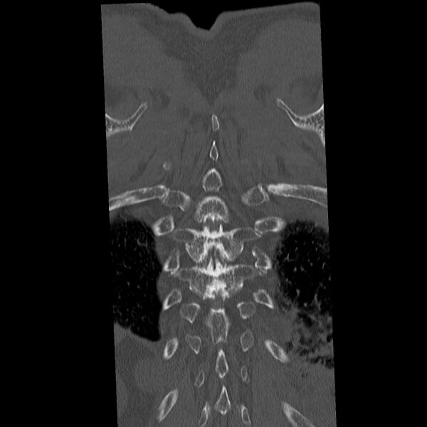 File:Acute and chronic vertebral compression fractures (Radiopaedia 31608-32494 Coronal bone window 43).jpg