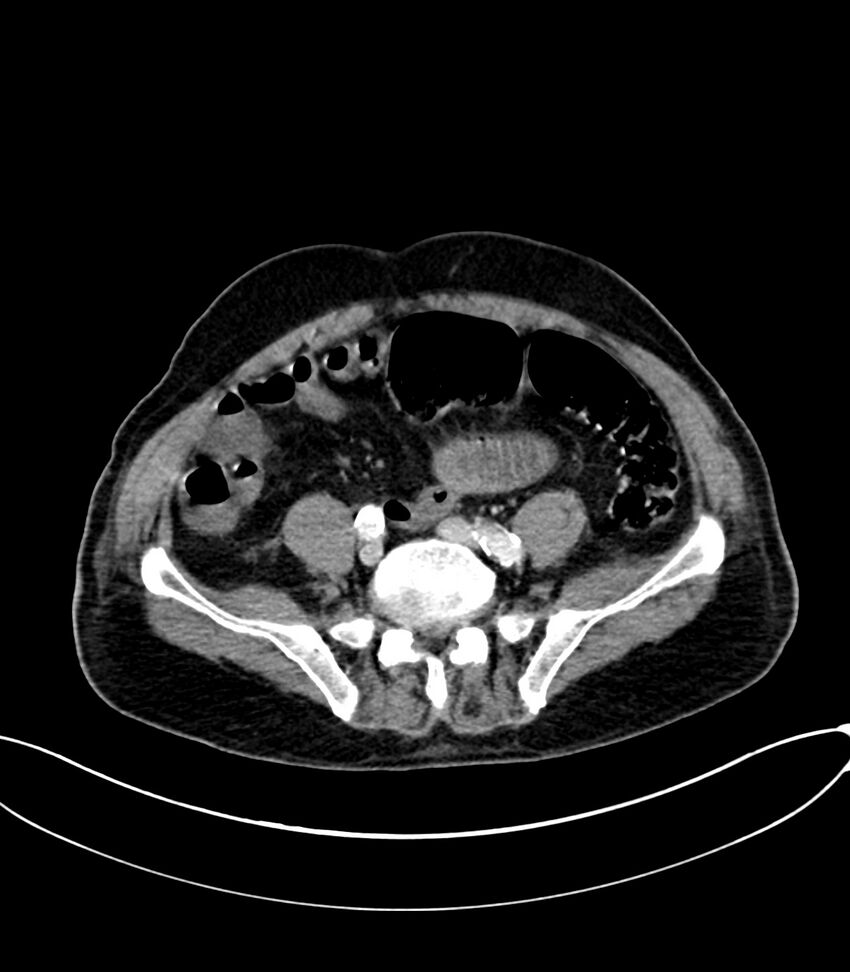 Acute arterial mesenteric ischemia (Radiopaedia 78238-90828 Axial C+ portal venous phase 100).jpg