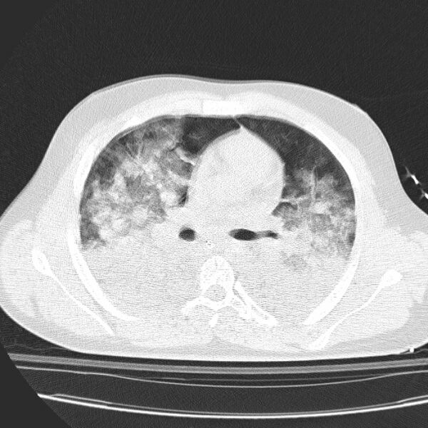File:Acute aspiration pneumonitis (Radiopaedia 33605-34703 Axial lung window 47).jpg