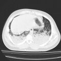 Acute aspiration pneumonitis (Radiopaedia 33605-34703 Axial lung window 75).jpg