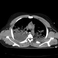 Acute aspiration pneumonitis (Radiopaedia 33605-34703 Axial non-contrast 36).jpg