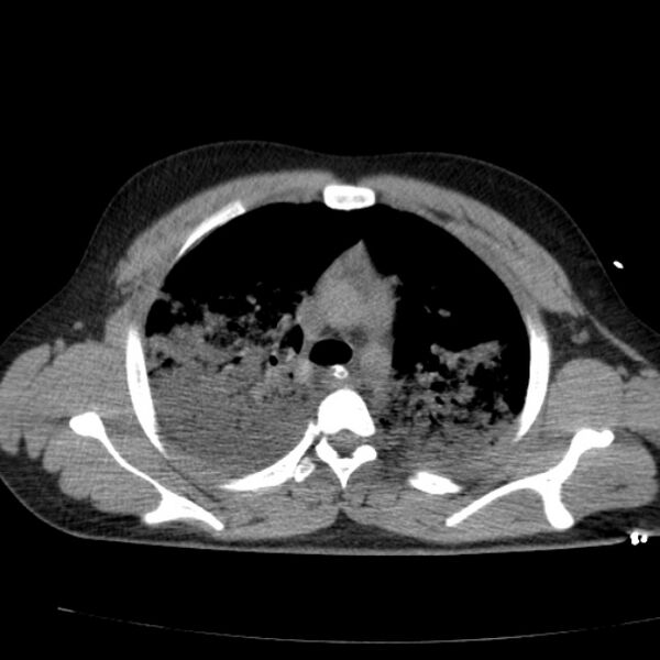 File:Acute aspiration pneumonitis (Radiopaedia 33605-34703 Axial non-contrast 36).jpg