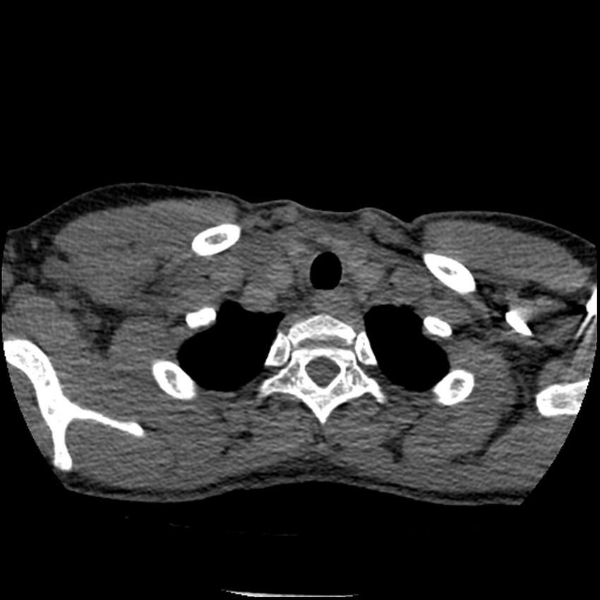 Acute chest syndrome - sickle cell disease (Radiopaedia 42375-45499 Axial C+ CTPA 19).jpg