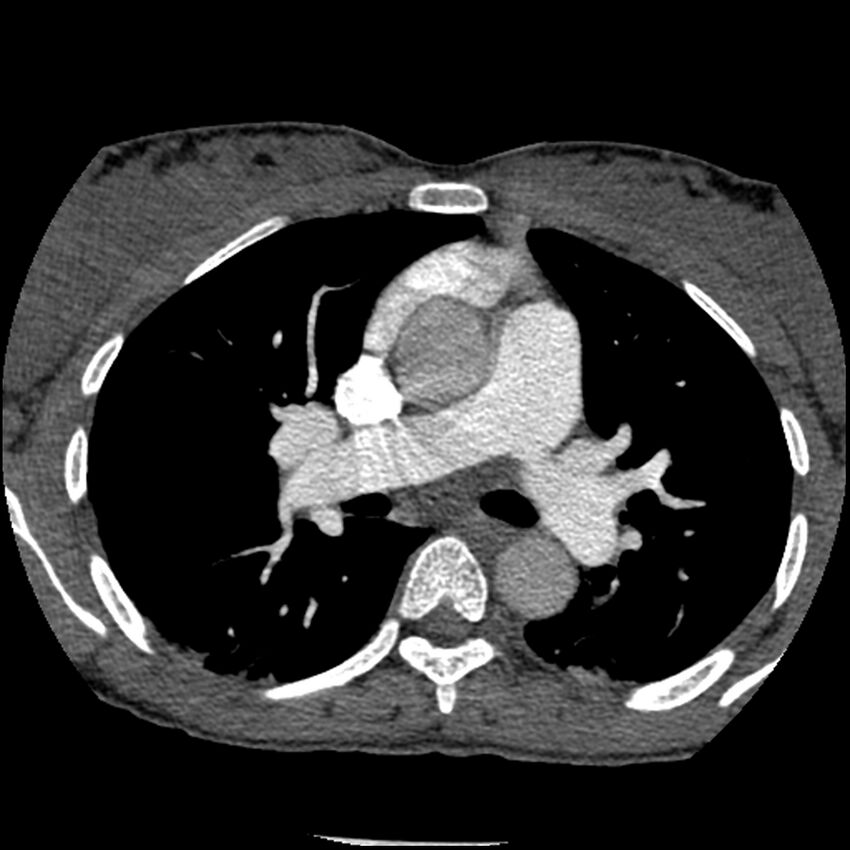 Acute chest syndrome - sickle cell disease (Radiopaedia 42375-45499 Axial C+ CTPA 81).jpg