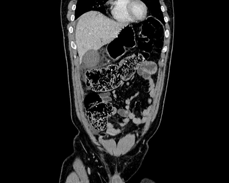 File:Acute cholecystitis (Radiopaedia 53216-59182 Coronal C+ portal venous phase 4).jpg