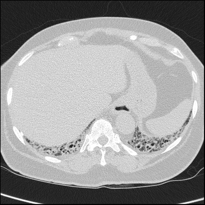Acute interstitial pneumonitis (Radiopaedia 45404-49453 Axial lung window 69).jpg