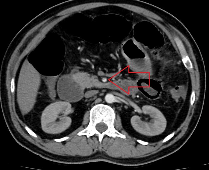Acute mesenteric ischemia - superior mesenteric artery thrombosis (Radiopaedia 73947-84776 Axial C+ arterial phase 38).jpg
