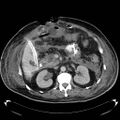 Acute pancreatic necrosis (Radiopaedia 13560-18503 Axial C+ portal venous phase 32).jpg