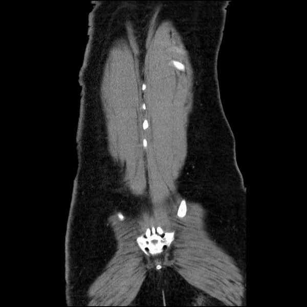 File:Acute pancreatitis (Radiopaedia 69236-79012 Coronal C+ portal venous phase 16).jpg