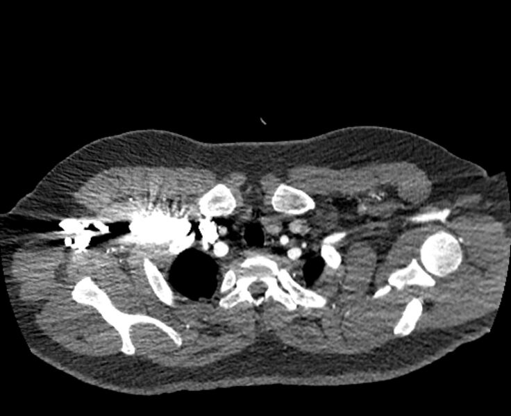 File:Acute pulmonary embolism with pulmonary infarcts (Radiopaedia 77688-89908 Axial C+ CTPA 1).jpg