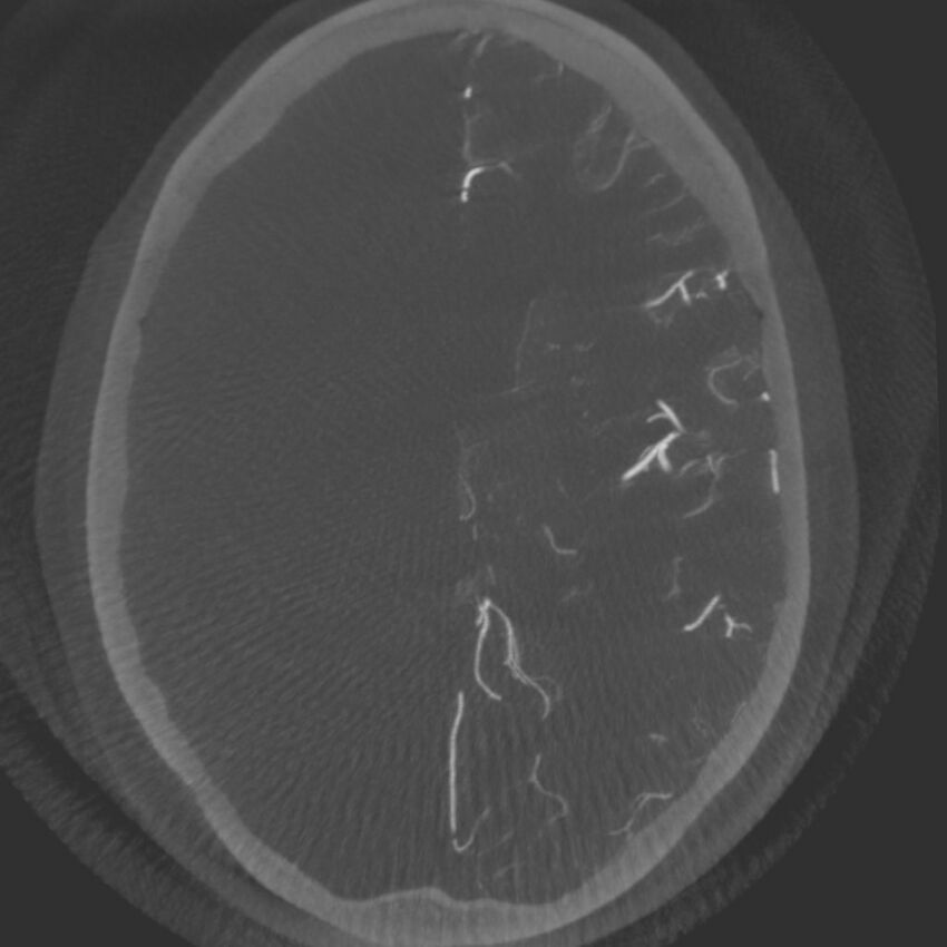 Acute subarachnoid hemorrhage and accessory anterior cerebral artery (Radiopaedia 69231-79010 C 42).jpg