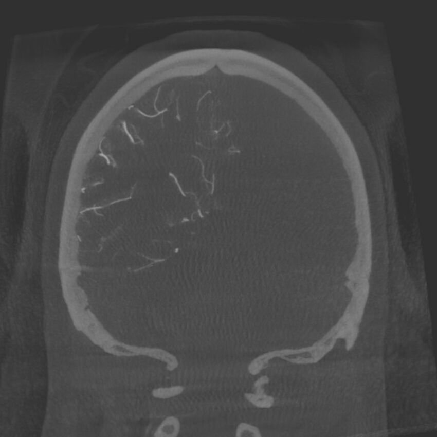 Acute subarachnoid hemorrhage and accessory anterior cerebral artery (Radiopaedia 69231-79010 Coronal arterial - MIP 78).jpg