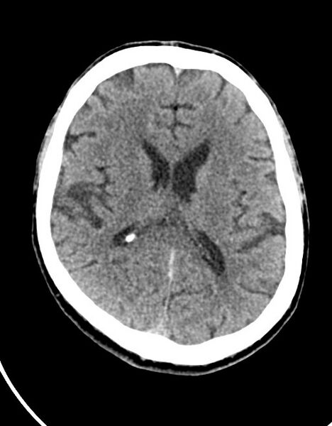 File:Acute superior cerebellar artery territory infarct (Radiopaedia 84104-99359 Axial non-contrast 32).jpg