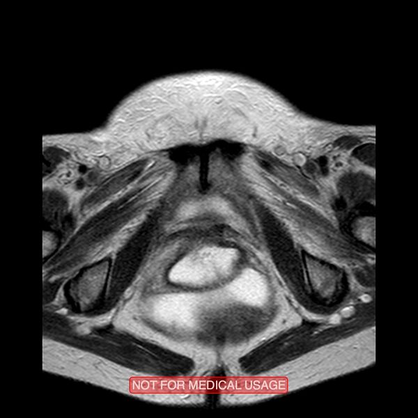 File:Adenocarcinoma of the cervix (Radiopaedia 28373-28615 Axial T2 3).jpg