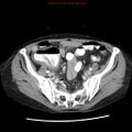 Adenocarcinoma of the colon (Radiopaedia 8191-9039 Axial liver window 58).jpg