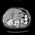 Adenocarcinoma of the colon (Radiopaedia 8191-9039 Axial renal excretory phase 12).jpg