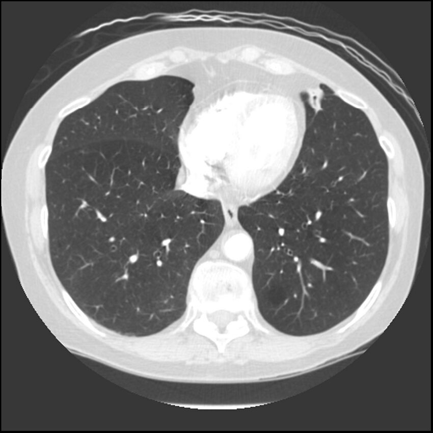 Adenocarcinoma of the lung (Radiopaedia 41015-43755 Axial lung window 89).jpg