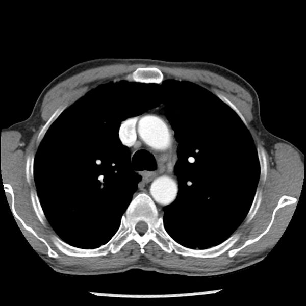 File:Adenocarcinoma of the lung - micropapillary predominant (Radiopaedia 42446-45563 Axial C+ portal venous phase 23).jpg