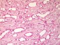 Adenomatoid tumor of the scrotum (pathology) (Radiopaedia 16175-15853 C 1).jpg