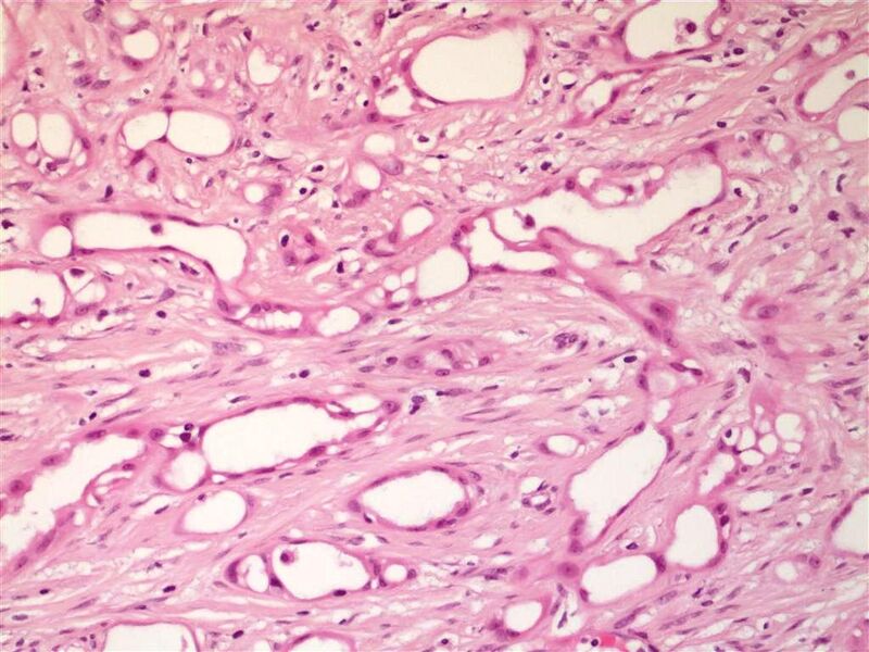 File:Adenomatoid tumor of the scrotum (pathology) (Radiopaedia 16175-15853 C 1).jpg