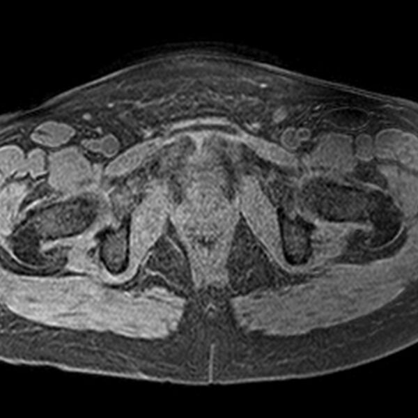 File:Adenomyoma of the uterus (Radiopaedia 9871-10439 Axial T1 fat sat 5).jpg